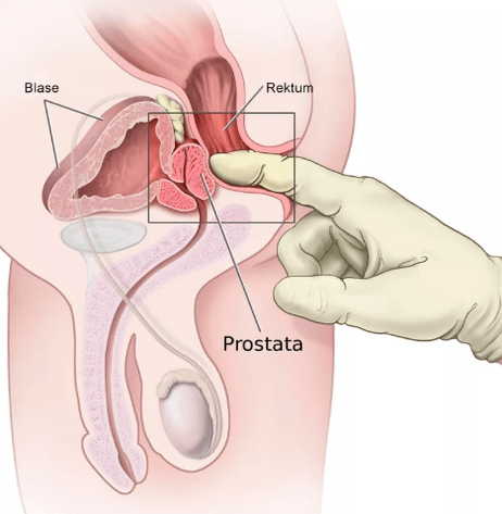 Massage de la prostate